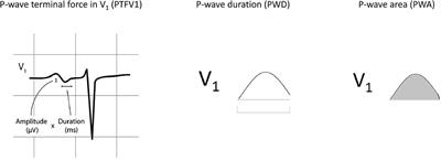 P-Wave Area Predicts New Onset Atrial Fibrillation in Mitral Stenosis: A Machine Learning Approach